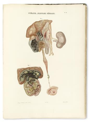 RAYER, PIERRE-FRANÇOIS-OLIVE. Traité des Maladies des Reins.  Atlas vol. only.  1837